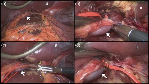 Laparoscopic view of (a) gastro-hepatic ligament, (b) patent ductus venosus (PDV), (c) loop encircling the PDV with a vascular clamp occluding the PDV and (d) partial occlusion of the PDV with tightened vessel loop secured with surgical clips. White arrow, PDV; green arrow, surgical clamp used for temporary occlusion of the PDV; #, retracted left lobe of the liver.