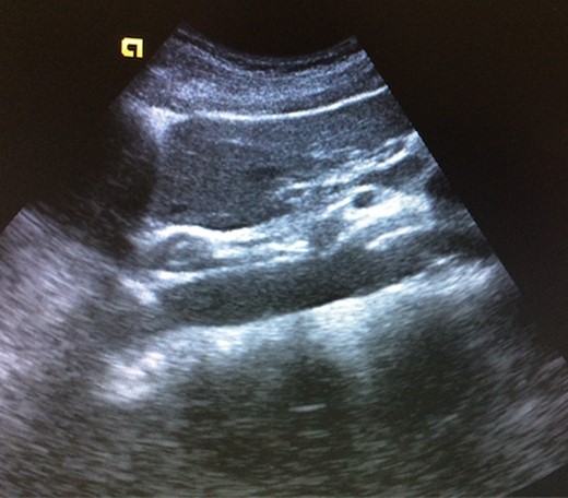 Abdominal ultrasound—reduced angle between abdominal aorta and superior mesenteric artery.