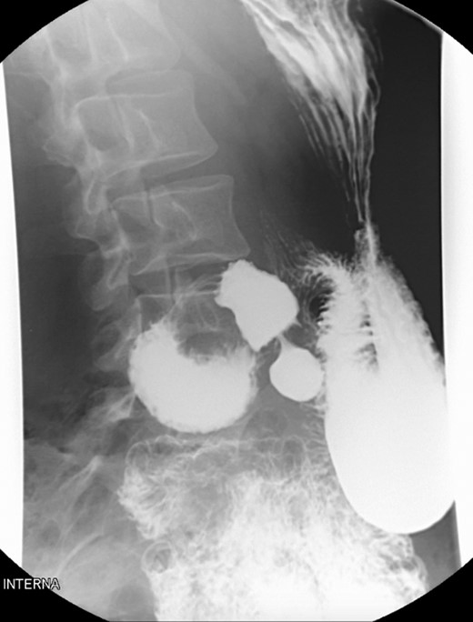 Contrasted intestinal series—distended stomach with delayed gastric emptying and reduced passage of contrast at the third portion of duodenum.