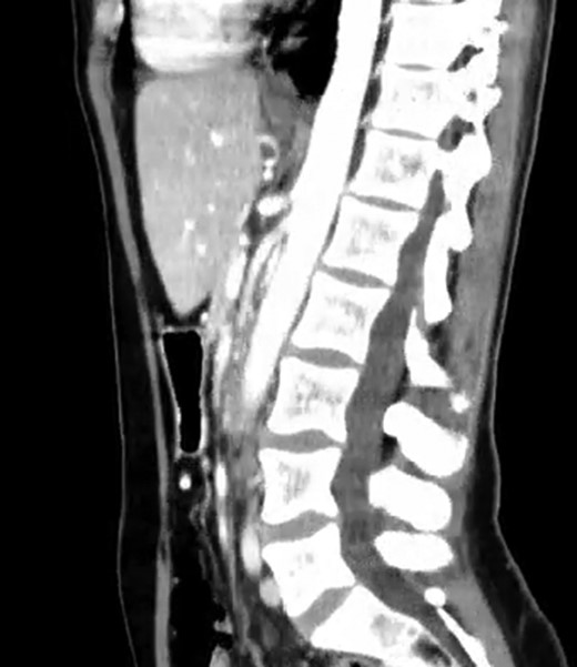 CT scan—sagittal CT image of reduced angle between AAA and SMA.