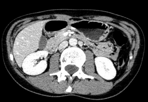 CT scan—axial CT image of obstruction of the third portion of duodenum between AAA and SMA.