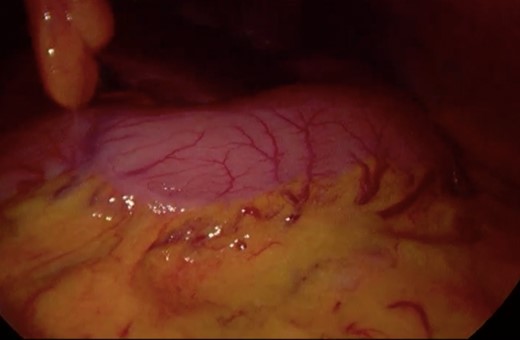 Surgery—initial laparoscopic view with distended stomach and proximal portions of duodenum.
