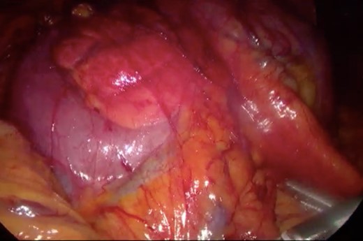 Surgery—laparoscopic visualization of the second and third portion of duodenum.
