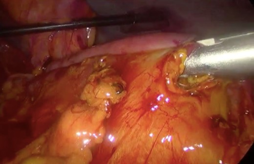 Surgery—laparoscopic stapled anastomosis between jejunum and second portion of duodenum.