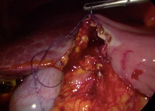 Surgery—laparoscopic hand-sew closure of the anastomosis.