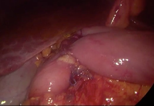 Surgery—final laparoscopic surgical view of laparoscopic duodenojejunostomy.