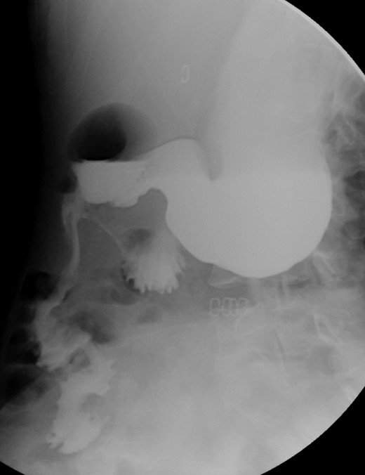 Post-operative contrasted intestinal series—delayed gastric emptying with without stenosis or leaks of the anastomosis.