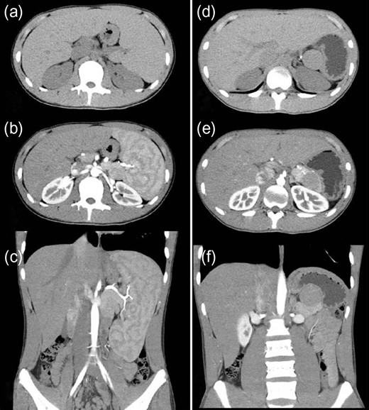 Computed tomography (CT) (before and after splenectomy). (a–c) Before splenectomy: Plain and enhanced CT shows a huge spleen and a 2-cm mass near or in the pancreatic tail. (d–f) After splenectomy: Plain and enhanced CT shows the mass in the pancreatic tail grows rapidly to 4 cm.