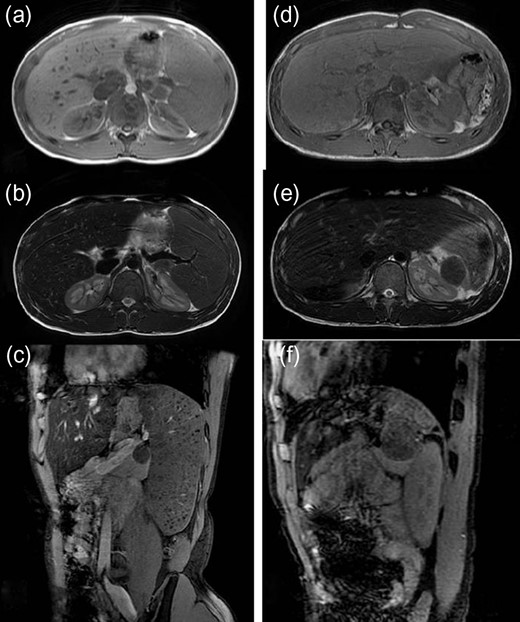 Magnetic resonance imaging (MRI) (before and after splenectomy). (a–c) Before splenectomy: MRI shows a huge spleen and a 2-cm mass in the pancreatic tail. (d–f) After splenectomy: MRI shows the mass in the pancreatic tail grows rapidly to 4 cm.