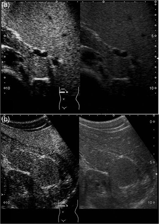 Sonazoid-enhanced ultrasonography Presplenectomy enhanced ultrasonography shows hypervascularity in the mass, located near the pancreatic tail and suspicious for an accessory spleen. The mass grows rapidly to 4 cm by 1 year after splenectomy (a: before splenectomy, b: after splenectomy).