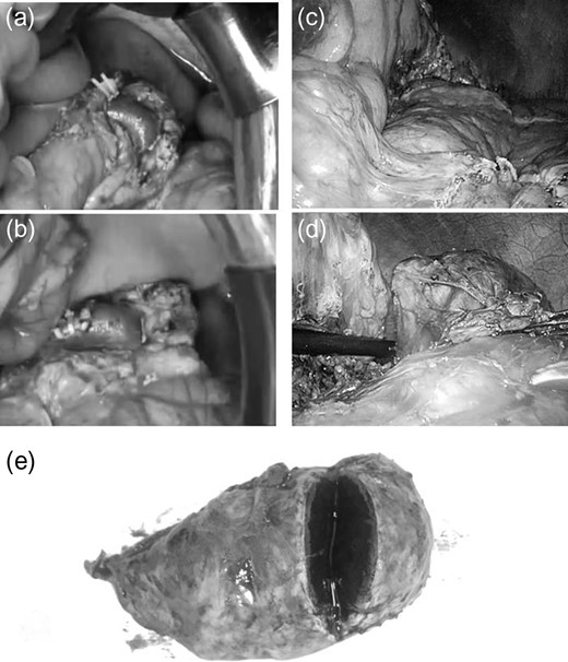 Intraoperative findings during splenectomy by laparotomy/laparoscopic distal pancreatectomy and the gross specimen The mass discovered during the preoperative examination is not found by inspection or intraoperative ultrasonography during splenectomy (a, b). But the laparoscopic ultrasonograhy reveals the mass in the pancreatic tail and a laparoscopic distal pancreatectomy is done (c, d). The gross specimen reveals a tumor, circumscribed by pancreatic tissue; histological evaluation shows an accessory spleen (e).
