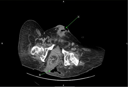 CT cross-sectional plane of pelvis. (a) Infiltrating SCC along suprapubic tract. (b) Air in left ischiorectal space from sacral sore.