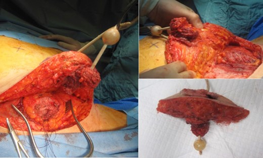 Elliptical en-bloc excision of SCC.