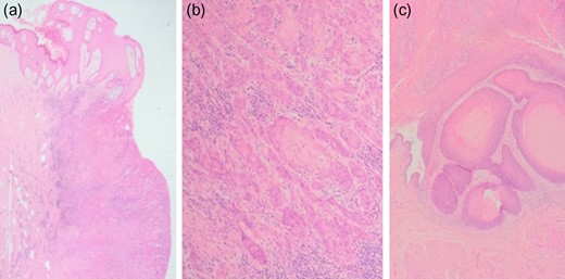 Histopathological images of SCC. Microscopy showed widely infiltrative squamous cell carcinoma involving full thickness of the specimen from skin to the bladder wall. No lymphovascular invasion was seen. The margins were clear although the deep detrusor muscle margin was clear by only 1 mm. (a) Photomicrograph showing abdominal wall skin with carcinoma (H&E ×1.25), (b) Photomicrograph showing infiltrating islands of squamous carcinoma in the subcutaneous tissue (H&E ×10), (c) Photomicrograph showing squamous carcinoma involving the bladder (H&E ×4).