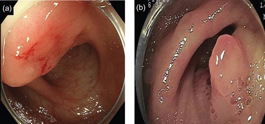 (a) Endoscopic findings of RS: A SMT-like lesion was observed. (b) Endoscopic findings of ileocecum: A salmon roe-like formation of erythrogenic mucosa at the ileum end was observed.