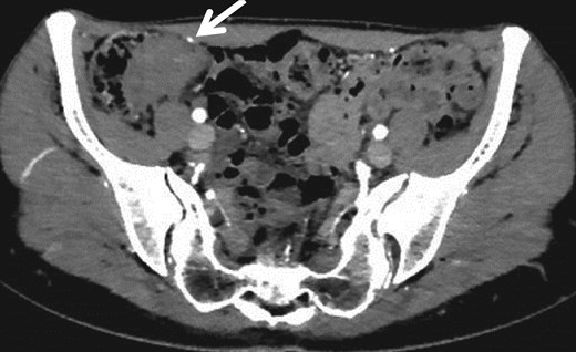 CT revealed a mass of ileocecum (arrow).