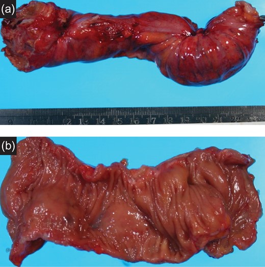 (a) Resected specimen (rectum): The serosal dimpling was observed. (b) Resected specimen (rectum): A SMT-like lesion was observed.