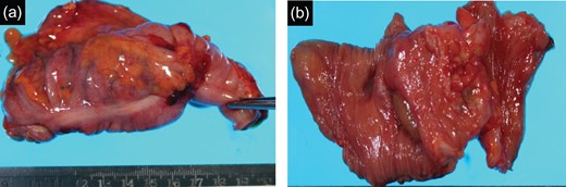 (a) Resected specimen (ileocecum): Serosal dimpling was also observed. (b) Resected specimen (ileocecum): A SMT-like lesion was also observed.