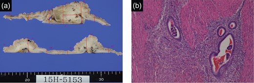 (a) Specimen (rectum): Contractures and ecchymosis were recognized. (b) Specimen (rectum, H.E. staining): Endometrial tissue was found in ecchymosis in muscularis.