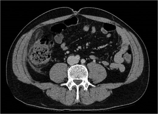Abdominal CT demonstrating soft tissue stranding anterio-lateral to the ascending colon/caecum without evidence of bowel wall thickening.