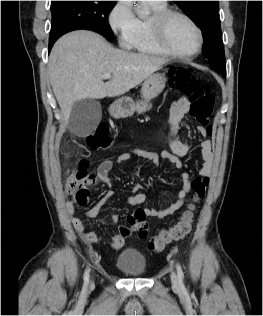 Abdominal CT demonstrating soft tissue stranding and odema inferior to a normal gallbladder, extending to the caecum.