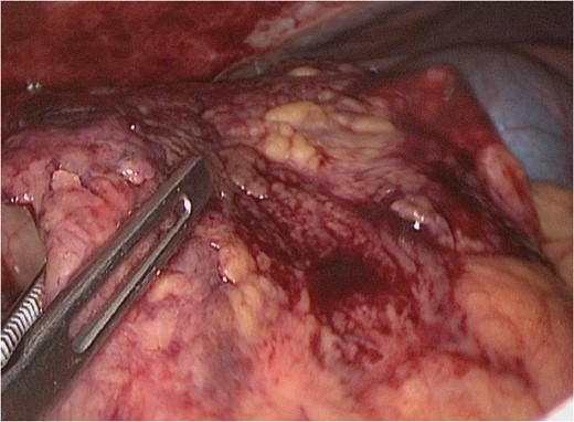 Right-segment omental infarction.