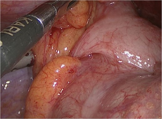 Normal caecum, appendix base and terminal ileum.
