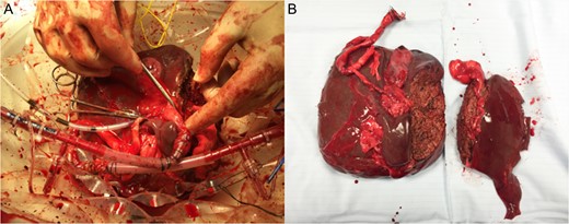 Splitting of DCD liver with concurrent NMP-L. (A) Appearance of the right lobe of liver after parenchymal transection whilst continuing NMP-L. (B) Appearance of liver lobes on completion of splitting and NMP-L.