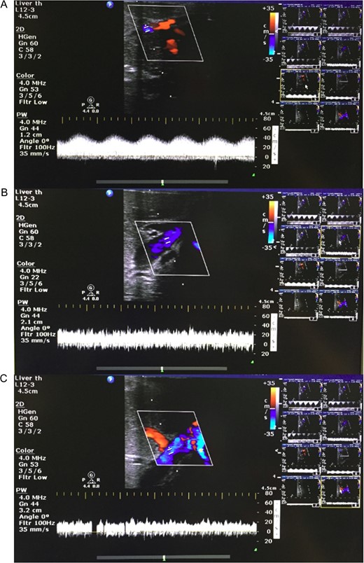 Representative Doppler ultrasound images of parenchyma from liver split with concurrent NMP-L. (A) Hepatic arteriolar waveform; (B) portal venous waveform; and (C) hepatic venous waveform.