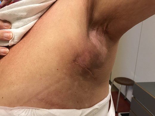 Fibrous seroma capsula of the left axilla after axillary clearance and radiotherapy.