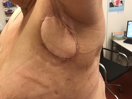 After surgical excision of seroma pocket and filling of the dead space with a latissimus dorsi skin-muscle flap.