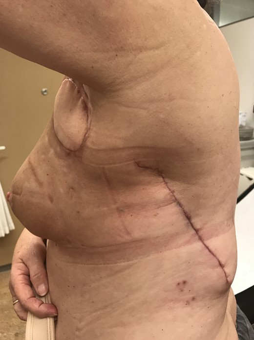 Lateral view after surgical excision of seroma pocket and filling of the dead space with a latissimus dorsi skin-muscle flap.