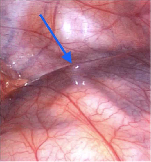 Peritoneal encapsulation cyst with small bowel contents at the bottom of the figure. Arrow demonstrates the attachment of the sac to the posterior abdominal wall peritoneum. Note the morphological similarity between the sac of the peritoneal encapsulation (bottom) and normal abdominal peritoneum (top).