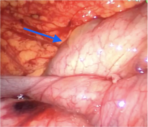 Apex of cyst (arrow) compressing transverse colon inferiorly with greater omentum visible superiorly.