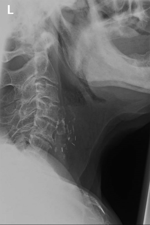 Lateral view soft tissue neck radiograph demonstrating calcified lesion at level of C4–C5. Presence of previous ligation clips noted from previous laryngectomy.