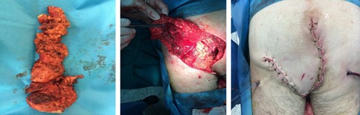 The specimen of abdominoperineal resection and the wound deficit covered with a flap from the gluteus maximus muscle.