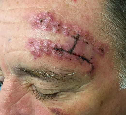 At 1 week post-surgery, the patient appeared to have developed an adverse tissue reaction with intense localized erythema surrounding each Nylon suture tract.