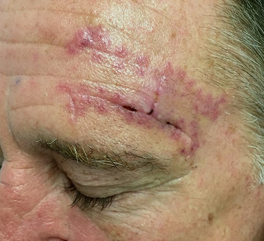 At 1 week after Nylon sutures removal, the tissue reaction had settled considerably without further intervention.