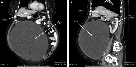 CT abdomen with IV and oral contrast; (A) coronal and (B) sagittal.
