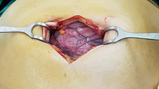 Midline laparotomy showing cyst.