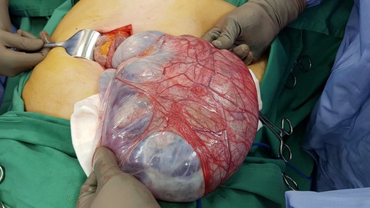 Resected cyst.