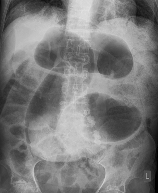Plain film abdominal X-ray taken on admission. Note coffee bean sign in Left iliac fossa.