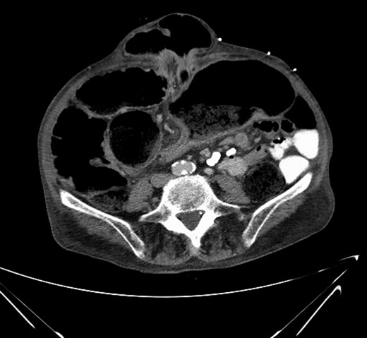 CT abdomen/pelvis. Note large umbilical hernia with loops of bowel within. Note abrupt transition point at centre of Image.