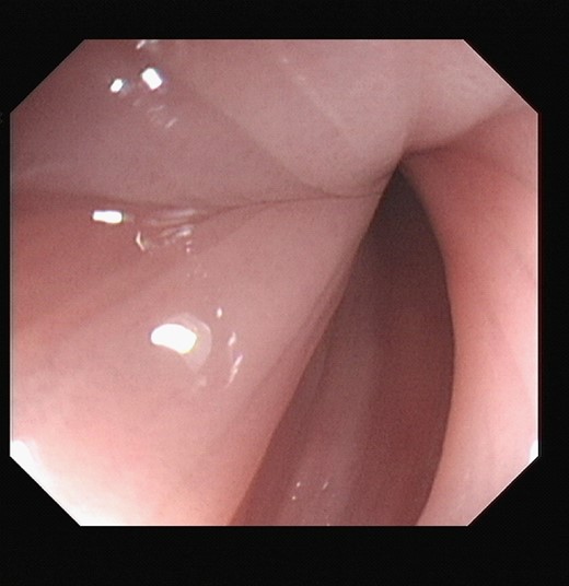 First sigmoidoscopy. Displaying healthy pink mucosa.