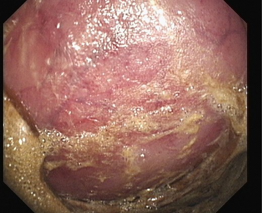 Repeat sigmoidoscopy: bluish discolouration of mucosa concerning for ischaemia.