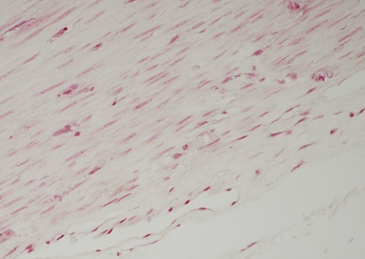 Histology: section of muscularis propria. Staining positive for both PAS and PAS D. Perle’s stain was negative.