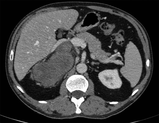 CT imaging of the lesion.