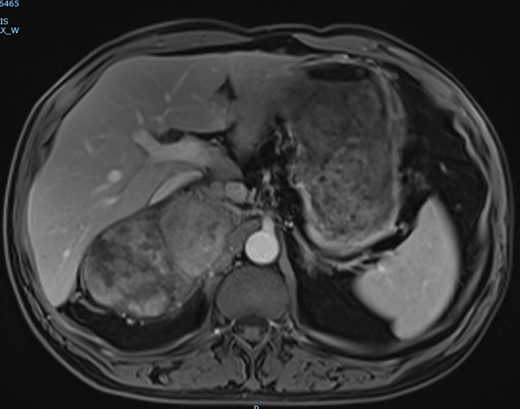 T1-weighted MRI image with gadolinium injection.