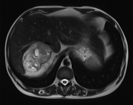 T2-weighted MRI image.