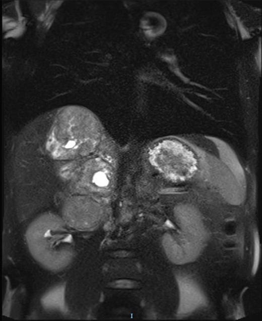 T2-weighted MRI coronal plane.